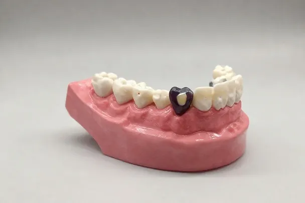 Modelo dental muestra una pieza oscurecida sobre una mesa clínica